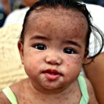 A-Filipino-child-with-measles.-Photo-Alejandro-Ernestopicture-alliance-via-Getty-Images–640×480
